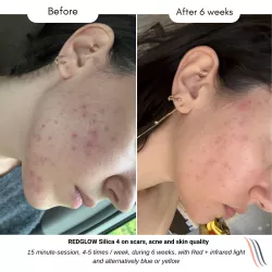 Silica 4 LED Mask Visage anti-âge et acné | Medi-Lum